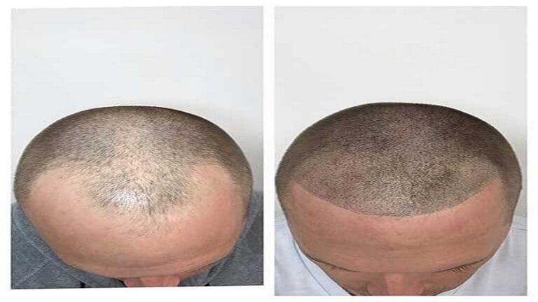 u774-Hair-Thinning-Treatment-Vadodara