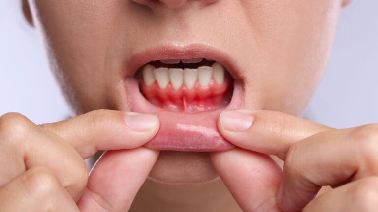 Abscess or Swelling? Why You Need an Emergency Dentist ASAP 1 Abscess-or-Swelling-Why-You-Need-an-Emergency-Dentist-ASAP