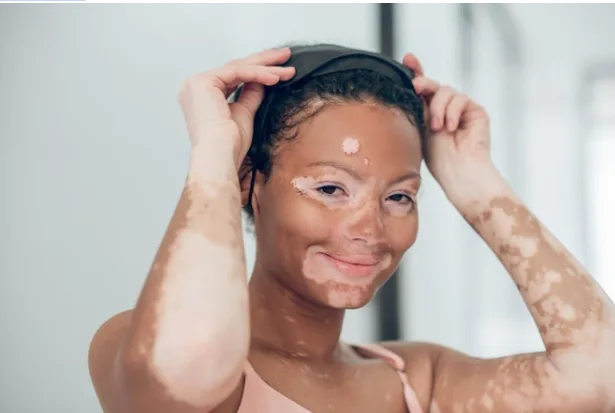 The Beauty of Diversity: Homeopathy, Skin-Pigmentation Acceptance & Natural Vitiligo Support 3 Screenshot-2025-11-28-092124