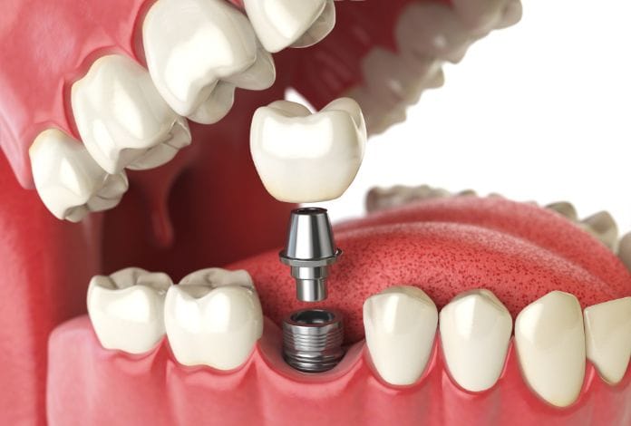 Titanium-Dental-Implant