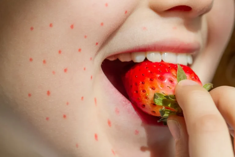 strawberry-allergy.jpg