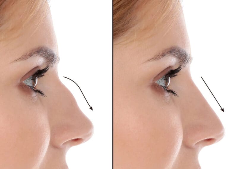 Rhinoplasty-in-dubai