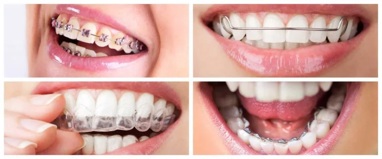 The-OrthBraces Then vs Now: How Modern Orthodontics Makes Smiles Easierodontist-Types-of-Braces